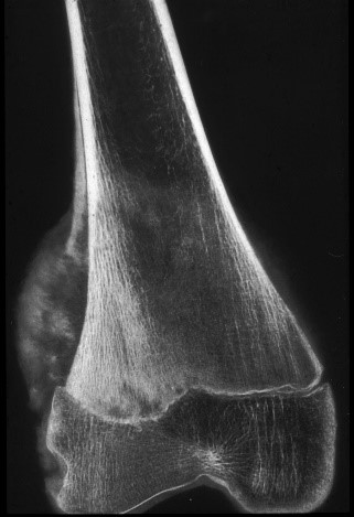 Osteosarcoma del femore, quadro radiografico